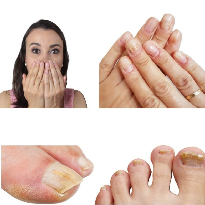 Parches impermeables para reparar hongos en las uñas