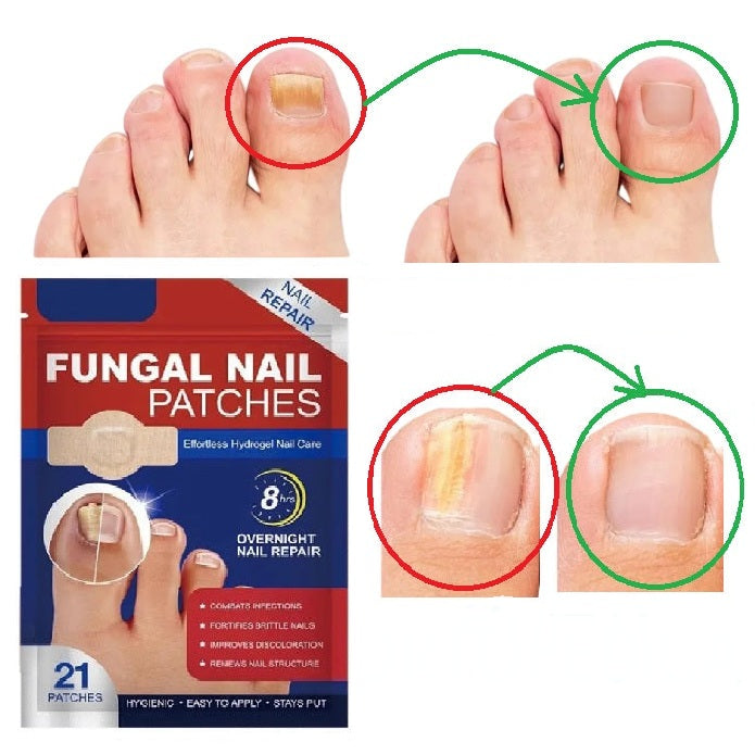 Parches impermeables para reparar hongos en las uñas